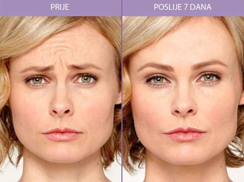 Botox ukljanjanje bora - DKC Farah